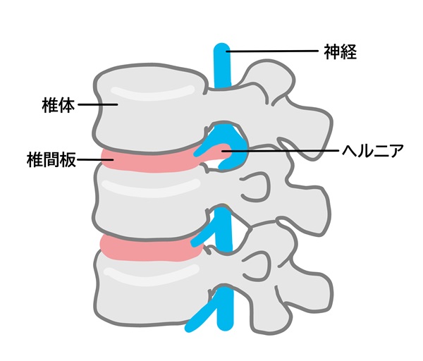 椎間板ヘルニア