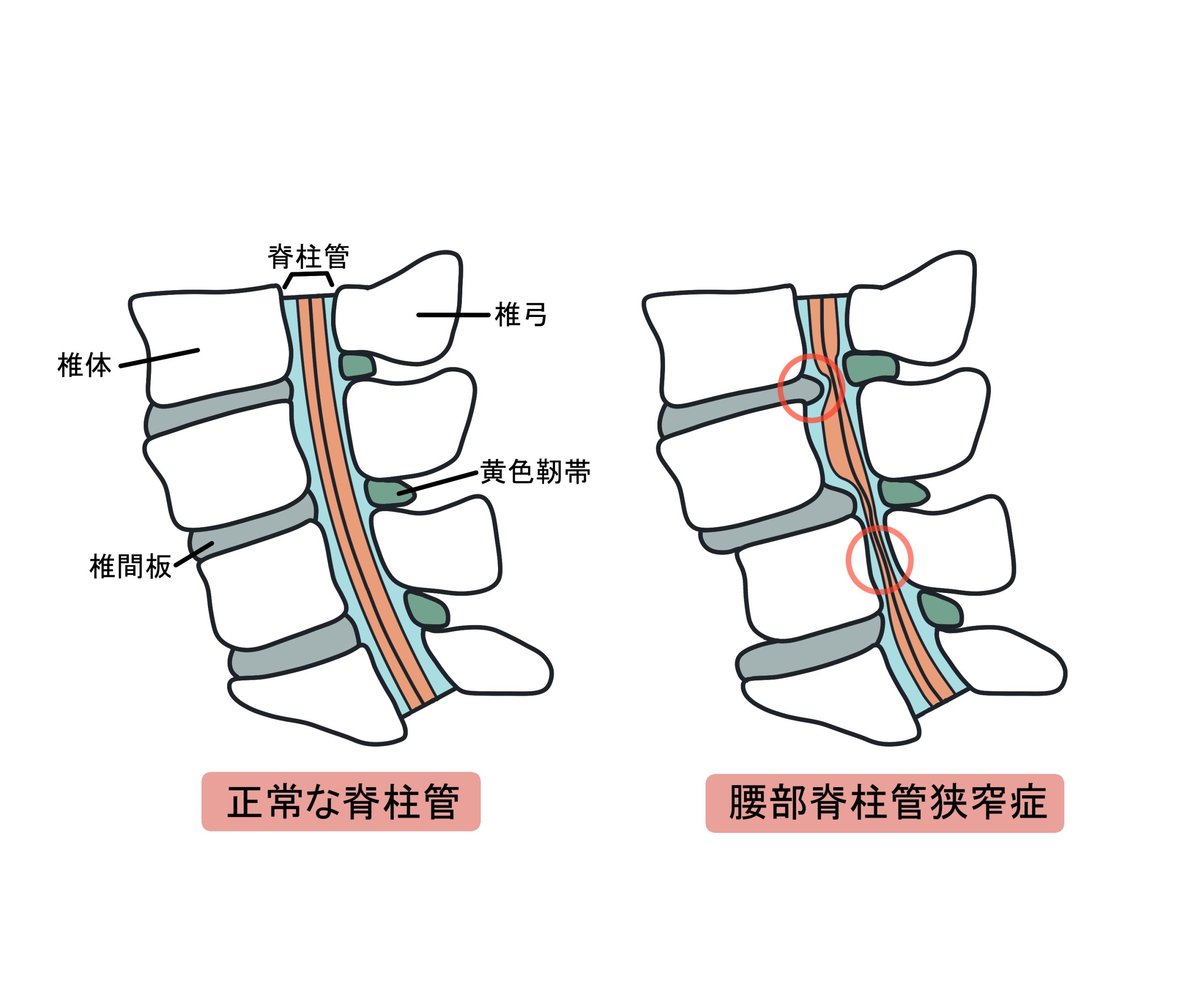 腰部脊柱管狭窄症